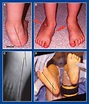 Foot and Ankle Deformities | Musculoskeletal Key