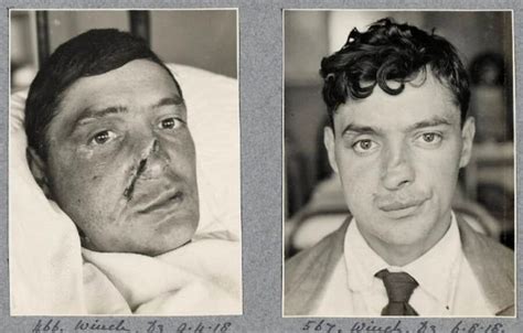 25 Before And After Pictures Of World War I Soldiers Who Were Helped By