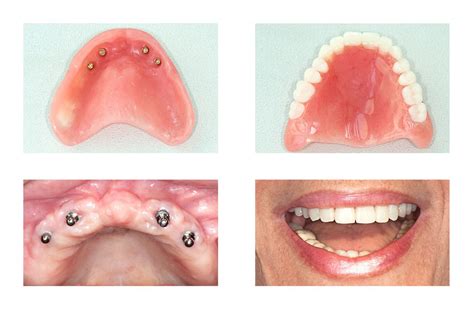 Implant Dentures Smile Again Denture Clinic