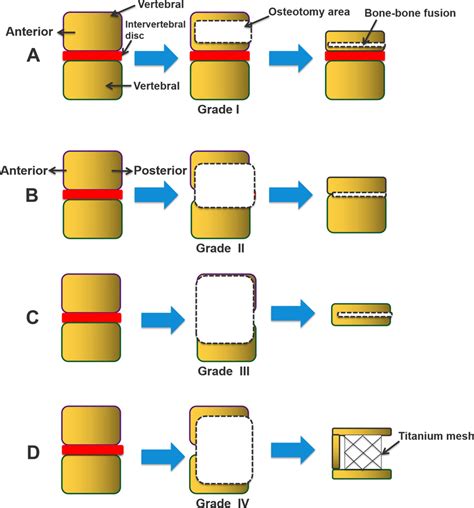 The Peo Osteotomy Grade Classification A Grade I For Scoliosis And