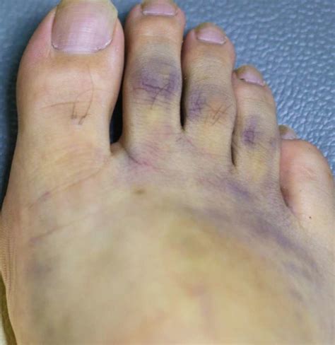 Foot Turns Purple When Not Elevated