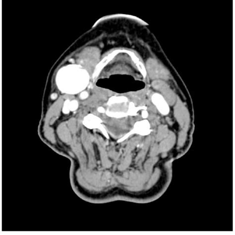 Photograph Showing High Arched Palate Download Scientific Diagram