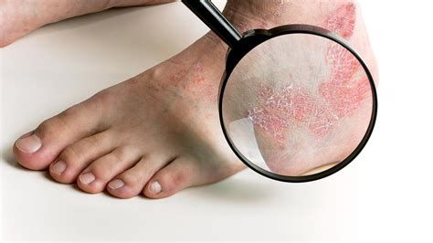 Psoriasis On Your Feet Psoriasis Everyday Health