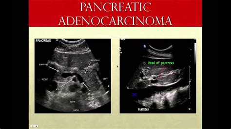 Pancreatic Adenocarcinoma From An Ultrasound Perspective Youtube