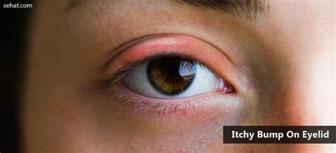 Itchy Bump On Eyelid Causes Types And Prevention