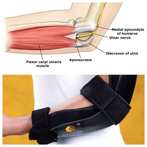 Cubital Tunnel Entrapment Of Proximal Ulnar Never At Elbow Between