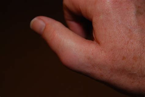 Related Keywords And Suggestions For Lump On Thumb Joint