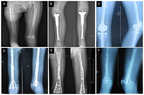 Treatment Of Osteosarcoma Around The Knee In Skeletally Immature Patients