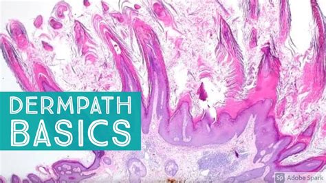 Basic Dermpath Cases Explained By A Dermatopathologist Youtube