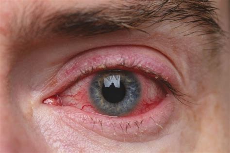 What Is Ocular Rosacea Causes And Treatments The Eye News