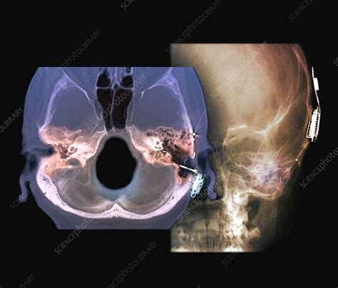 Cochlear Implant Ct Scan And X Ray Stock Image C0480627 Science
