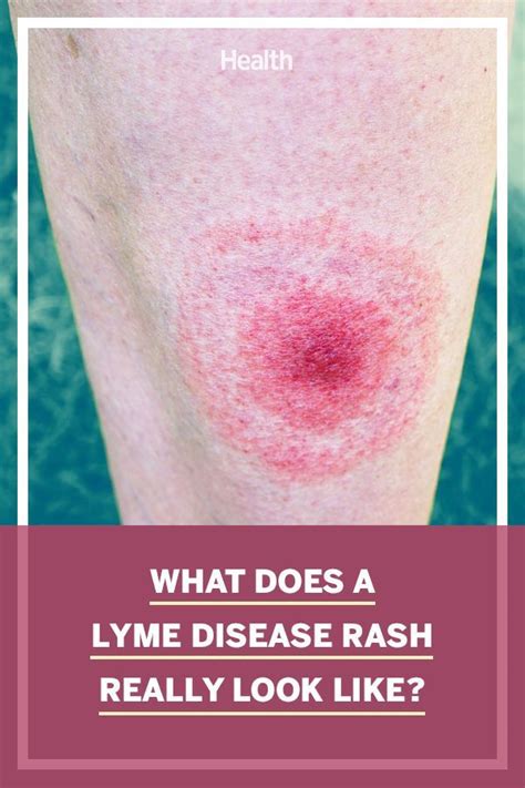 5 Types Of Rashes That Can Be Signs Of Lyme Disease Lyme Disease