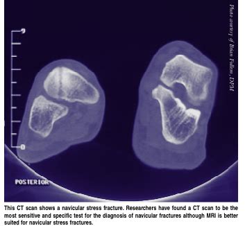 What You Should Know About Navicular Stress Fractures