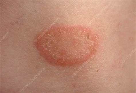 Ringworm Fungal Infection Stock Image C0473495 Science Photo Library