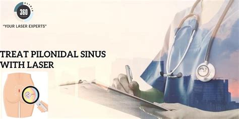 How To Treat Pilonidal Sinus With Laser Operation