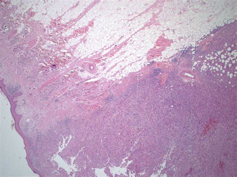 Pathology Outlines Case Of The Week 387