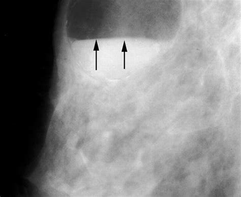 Radiologyspirit Breastgalactocele