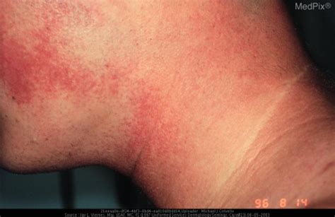 Diabetic Skin Problems And Diabetes Rash And How To Treat Them
