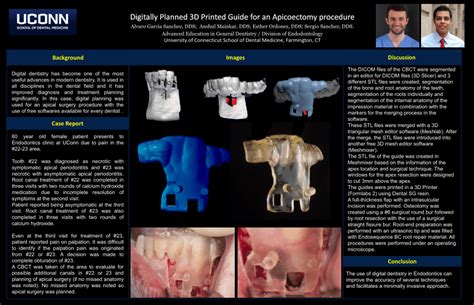 Pdf Digitally Planned 3d Printed Guide For An Apicoectomy Procedure