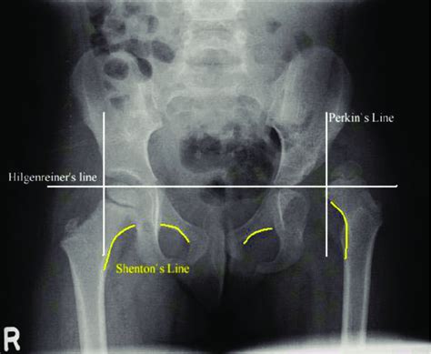Hip And Pelvis X Ray