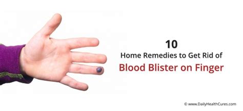 Blood Blister On Finger 10 Effective Home Remedies That Can Help