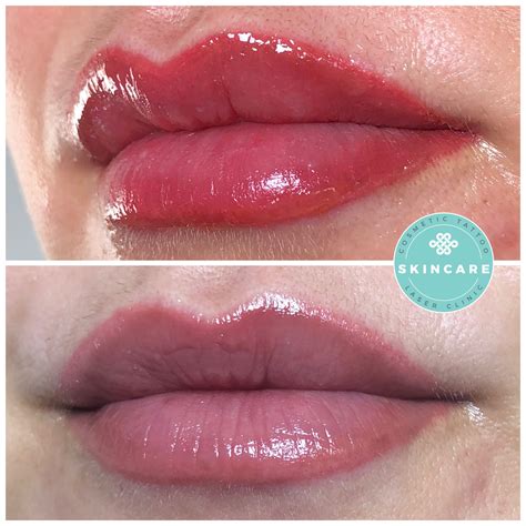 Lip Tattooing Skincare Laser Clinic