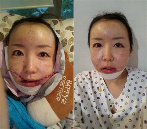 Plastic Surgery Experience Plastic Surgery Review In South Korea