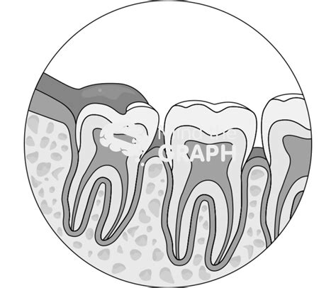 Pericoronitis Semi Impacted Wisdom Tooth Zoom