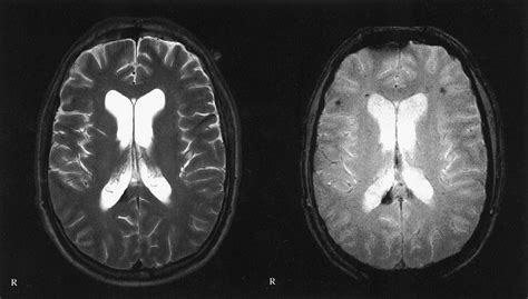43 Diffuse Axonal Brain Injury Mri Images Richard J Farmer