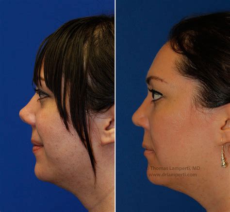 Photos Upturned Nose Rhinoplasty Case Study Seattle Facial Plastic