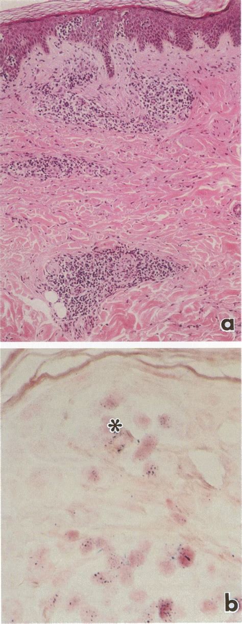 Case 7 Smoldering Type A Pautriers Microabscesses And Perivascular