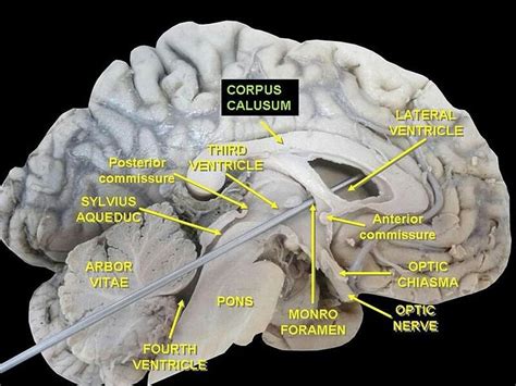 Corpus Callosum Corpus Callosum Brain Anatomy Brain Images