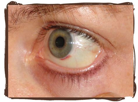 Why Did My Eye Turn Red Subconjuctival Hemorrhage Patients Lounge