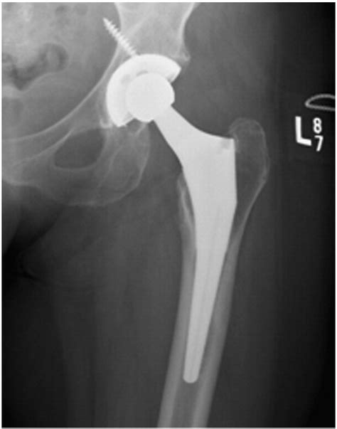 Iliopsoas Tendonitis Due To The Protrusion Of An Acetabular Component Fixation Screw After Total