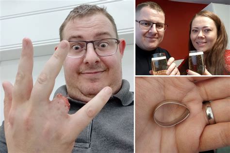 Newlyweds Ring Finger Ripped Off After His Wedding Band Got Caught On A Fence