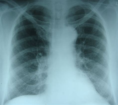 Pulmonary Edema X Ray Chest Pa View All About Cardiovascular System