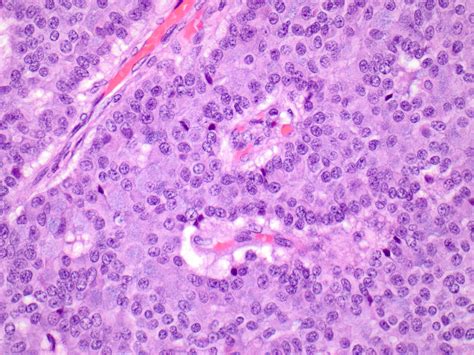Pathology Outlines Solid Papillary Carcinoma