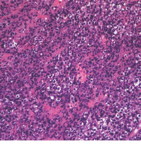 Figure 3 From Primary Breast Diffuse Large B Cell Lymphoma In A 42 Year