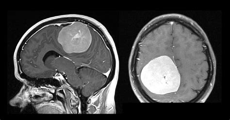 1 kapsul 60sen, 2 kali sehari sebagai gaya hidup sihat bebas kanser. Kanser Otak: Punca, Simptom dan Rawatan - The Diagnosa