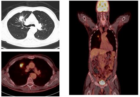 Pulmonary Nodule Clinic Charter Radiology