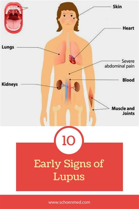 10 Early Signs Of Lupus With Images Thyroid Disease Symptoms Lupus