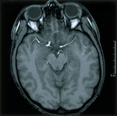 Normal Brain Mri With Contrast Images Radiologia