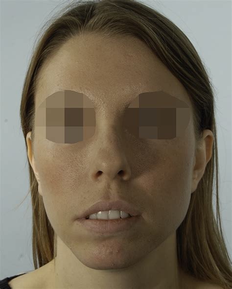 Asymmetrical Face Surgery Before And After