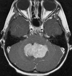 Tumor Histology Neuro Oncology Mitch Medical Healthcare