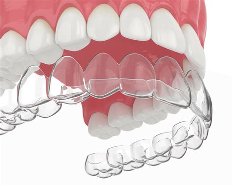 Fort Worth Orthodontist Offers Cosmetic Braces And Aligners For Your