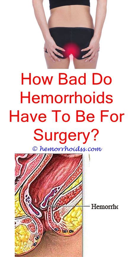 Pin On External Hemorrhoid