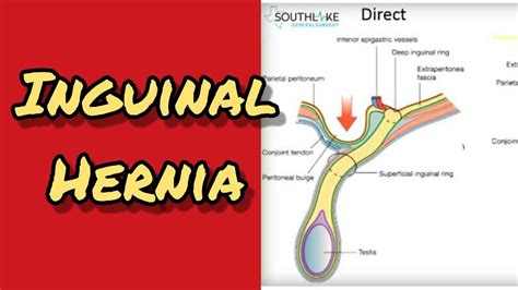 Inguinal Hernia Direct And Indirect Youtube