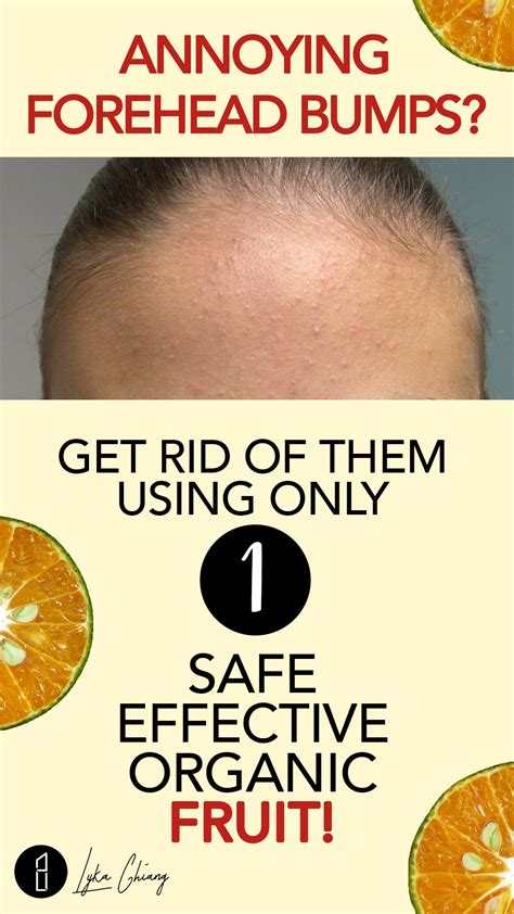 How To Get Rid Of Tiny Bumps On Forehead Face Fast Fungal Acne How I