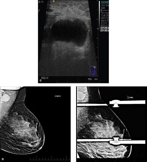 Breast Ultrasound Radiology Key