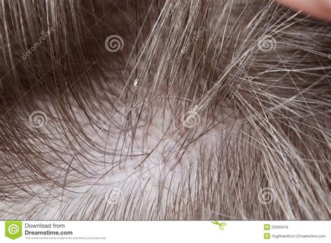 Lice Stock Photo Image Of Lice Nits Eggs Forehead 23263416